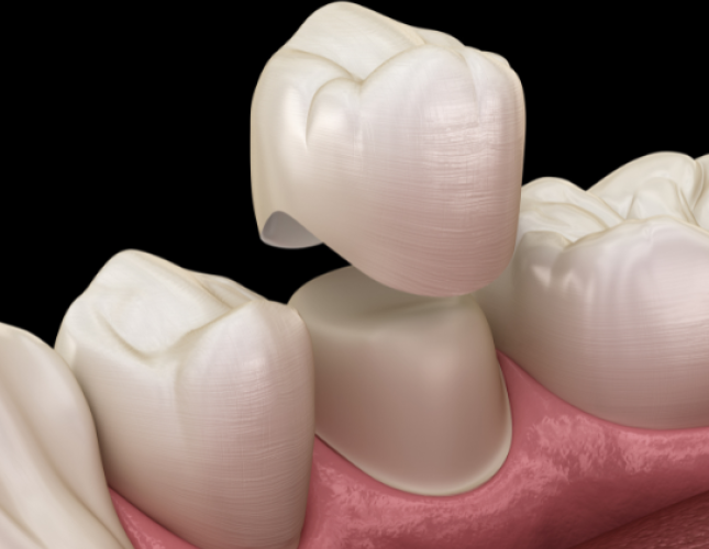 What Exactly Are Dental Crowns?